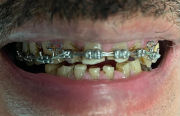 Braces Before